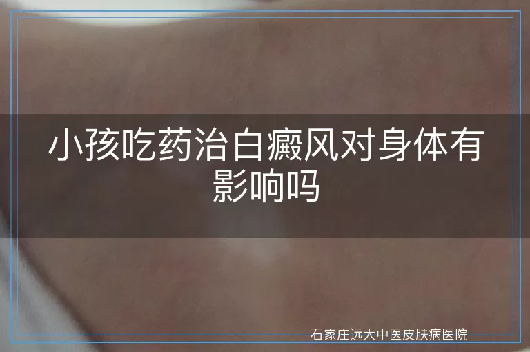 小孩吃药治白癜风对身体有影响吗