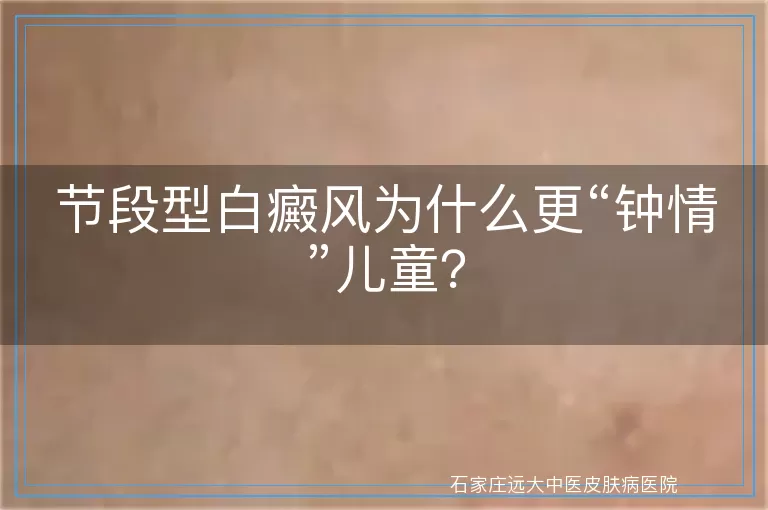 节段型白癜风为什么更“钟情”儿童？