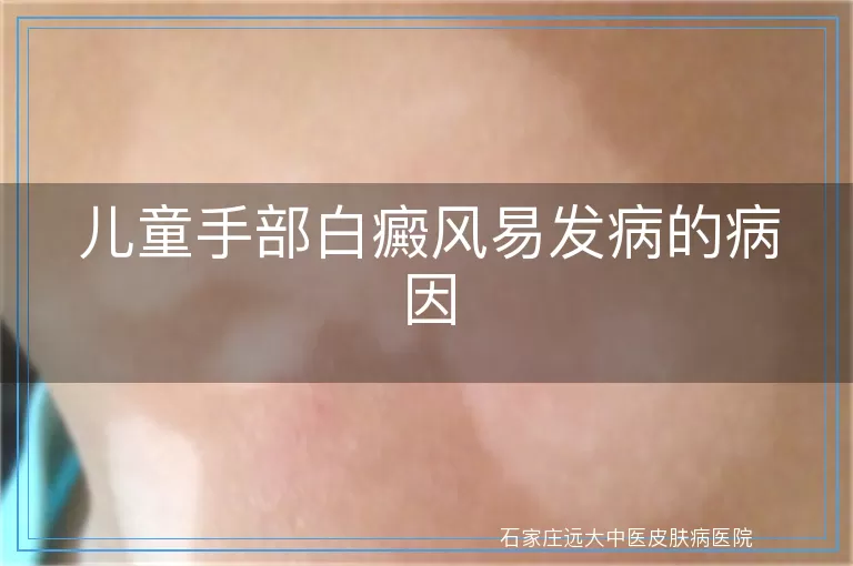 儿童手部白癜风易发病的病因