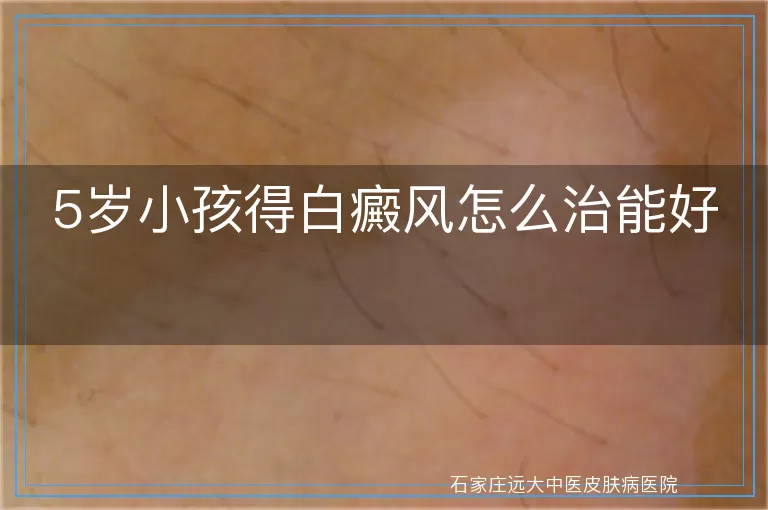 5岁小孩得白癜风怎么治能好