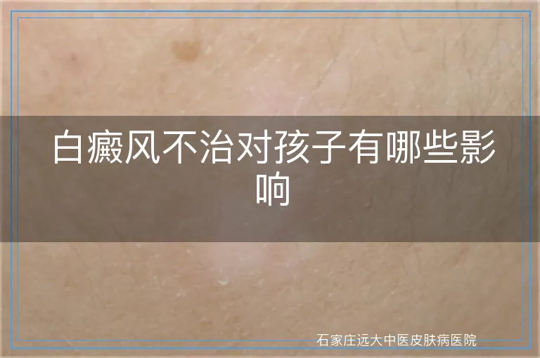 白癜风不治对孩子有哪些影响
