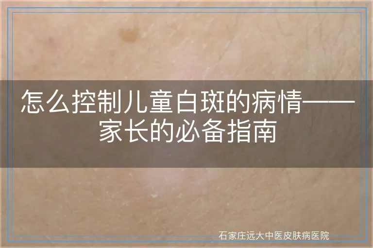 怎么控制儿童白斑的病情——家长的必备指南