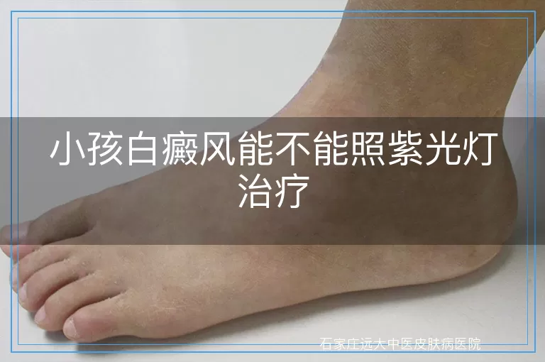 小孩白癜风能不能照紫光灯治疗