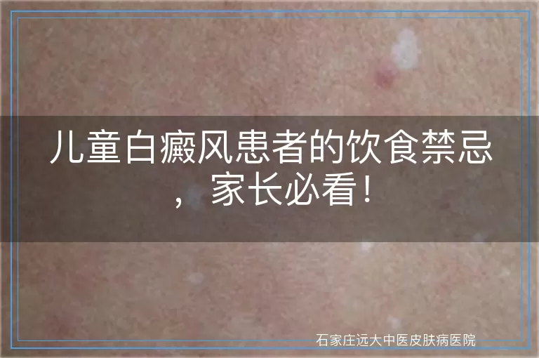 儿童白癜风患者的饮食禁忌，家长必看！