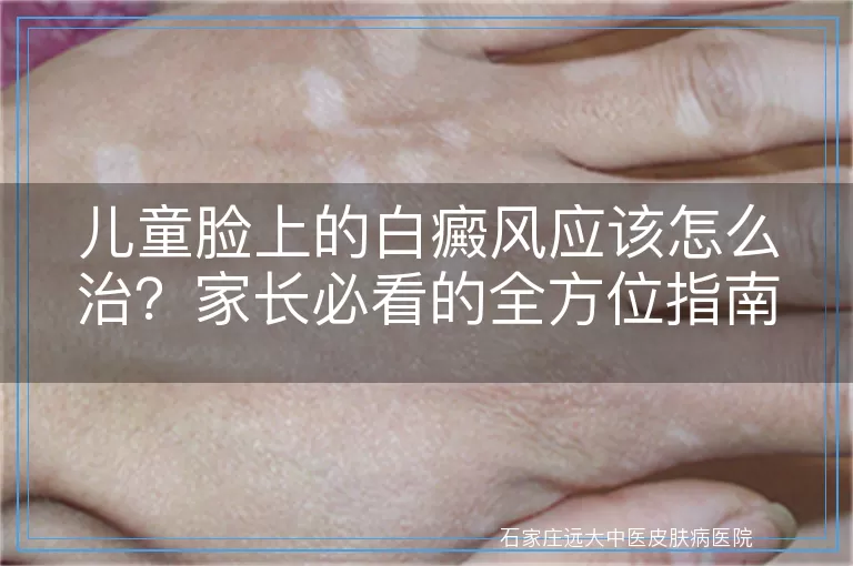 儿童脸上的白癜风应该怎么治？家长必看的全方位指南