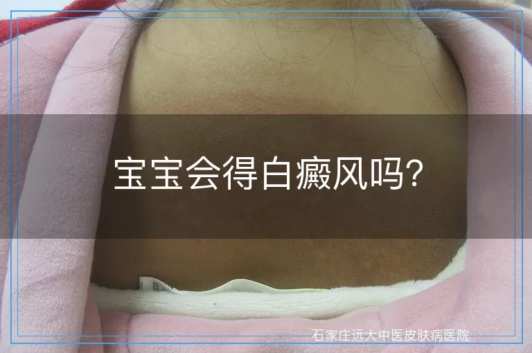 宝宝会得白癜风吗？