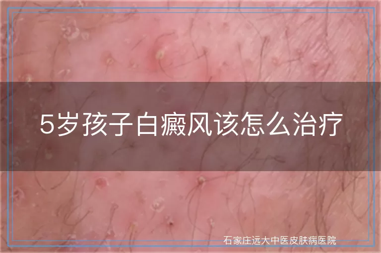 5岁孩子白癜风该怎么治疗