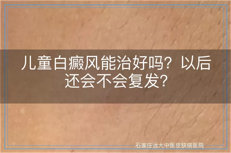 儿童白癜风能治好吗？以后还会不会复发？