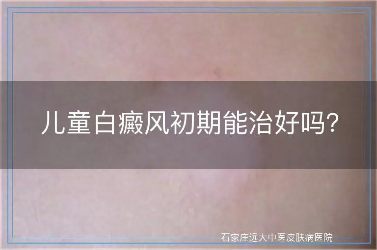 儿童白癜风初期能治好吗？