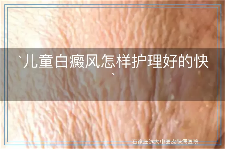 儿童白癜风怎样护理好的快