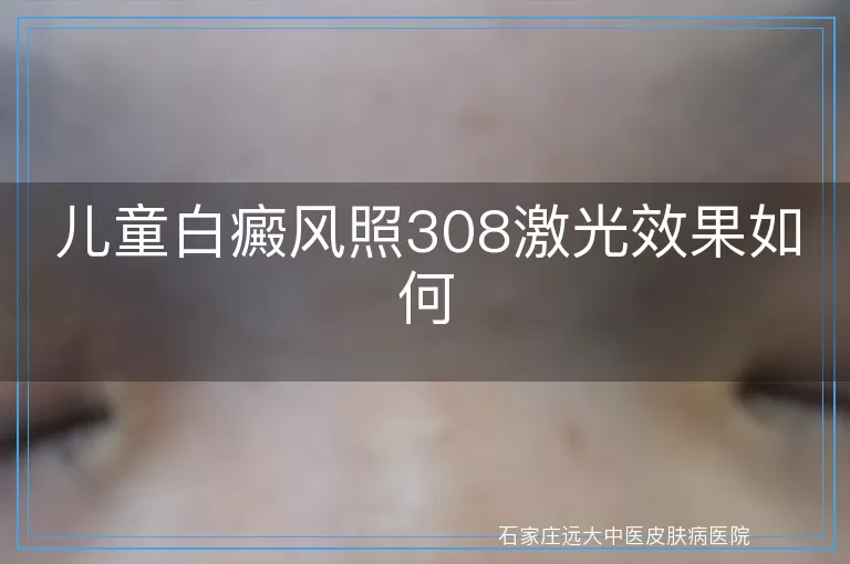 儿童白癜风照308激光效果如何