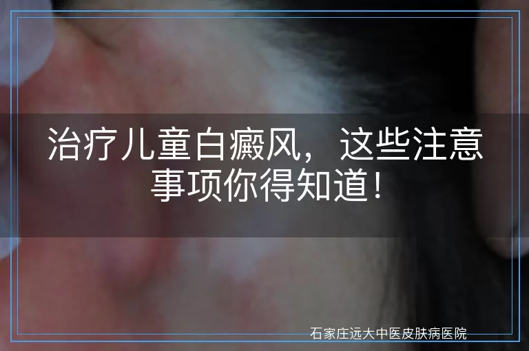 治疗儿童白癜风，这些注意事项你得知道！