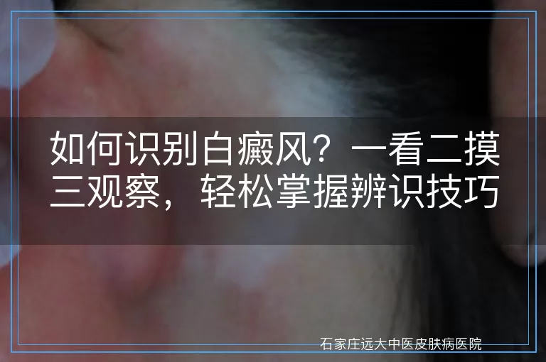 如何识别白癜风？一看二摸三观察，轻松掌握辨识技巧