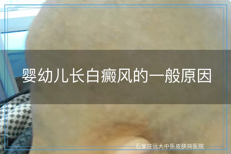婴幼儿长白癜风的一般原因