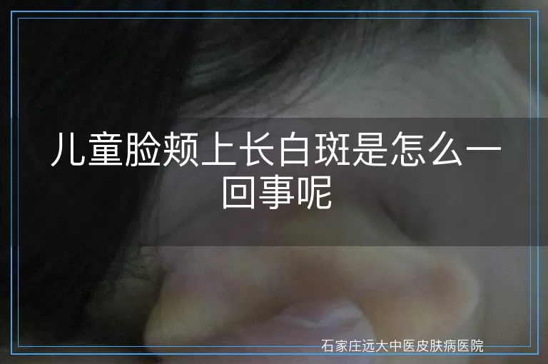 儿童脸颊上长白斑是怎么一回事呢