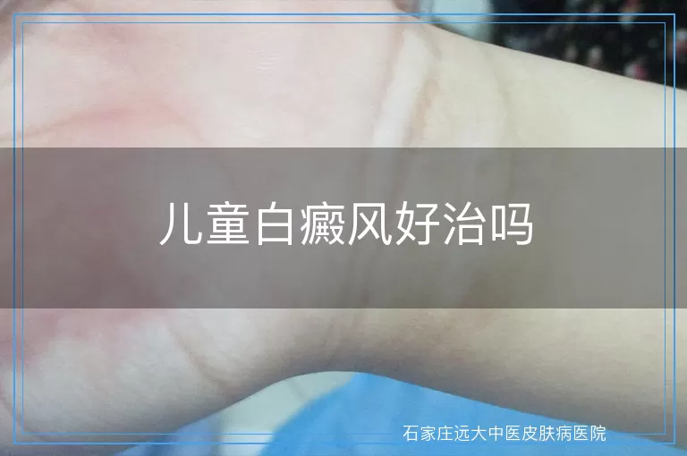 儿童白癜风好治吗