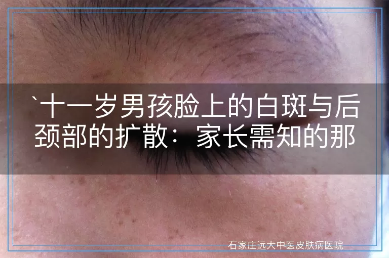 十一岁男孩脸上的白斑与后颈部的扩散：家长需知的那些事儿