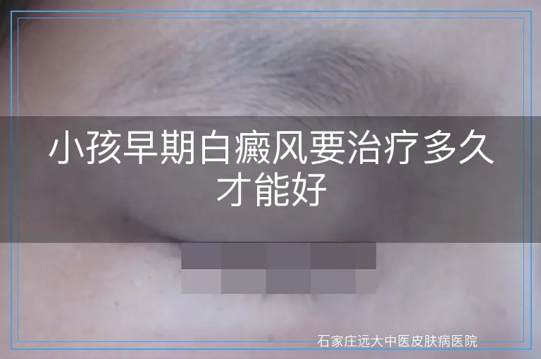 小孩早期白癜风要治疗多久才能好