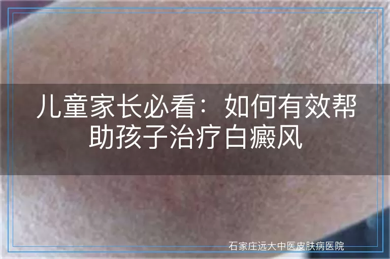 儿童家长必看：如何有效帮助孩子治疗白癜风