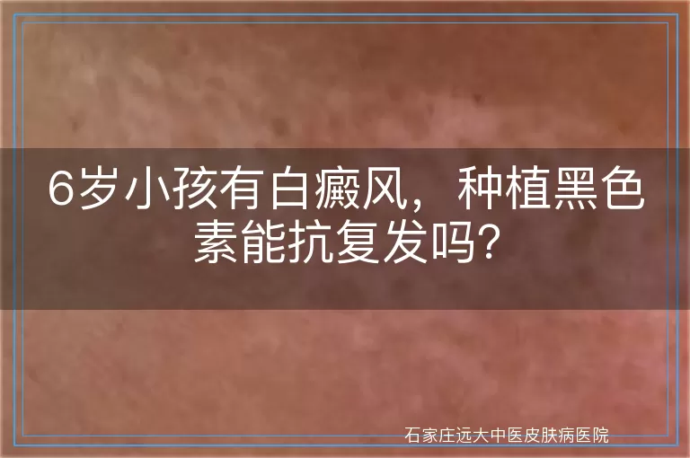 6岁小孩有白癜风，种植黑色素能抗复发吗？