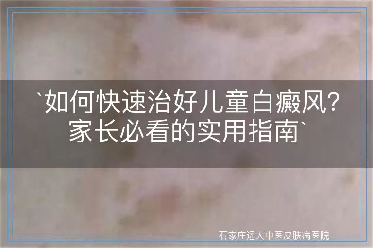 如何快速治好儿童白癜风？家长必看的实用指南