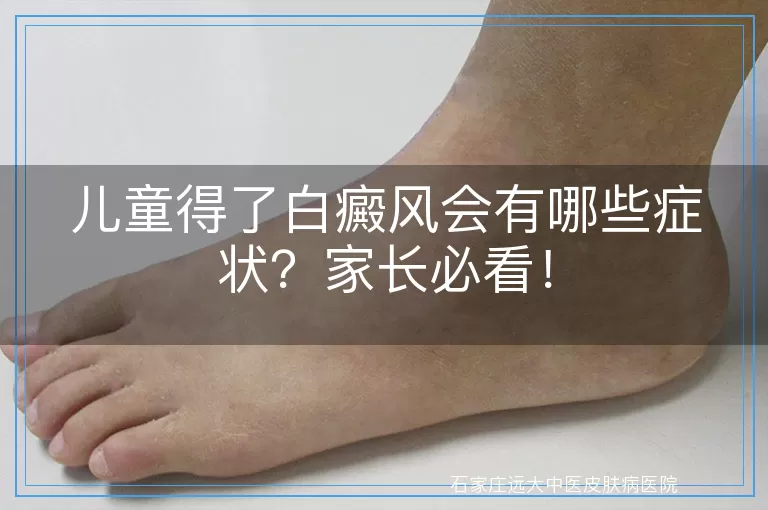儿童得了白癜风会有哪些症状？家长必看！