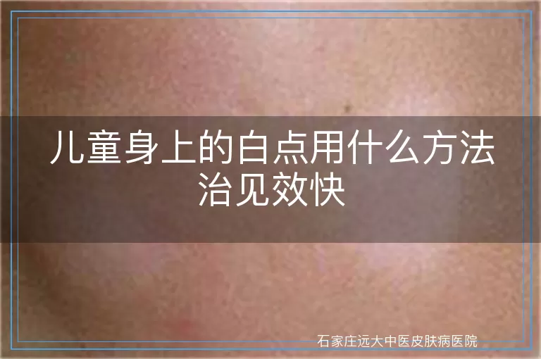 儿童身上的白点用什么方法治见效快