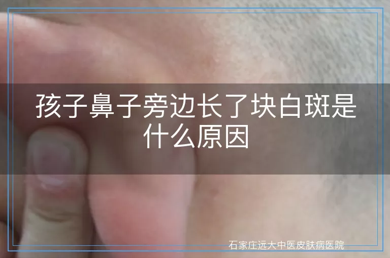 孩子鼻子旁边长了块白斑是什么原因