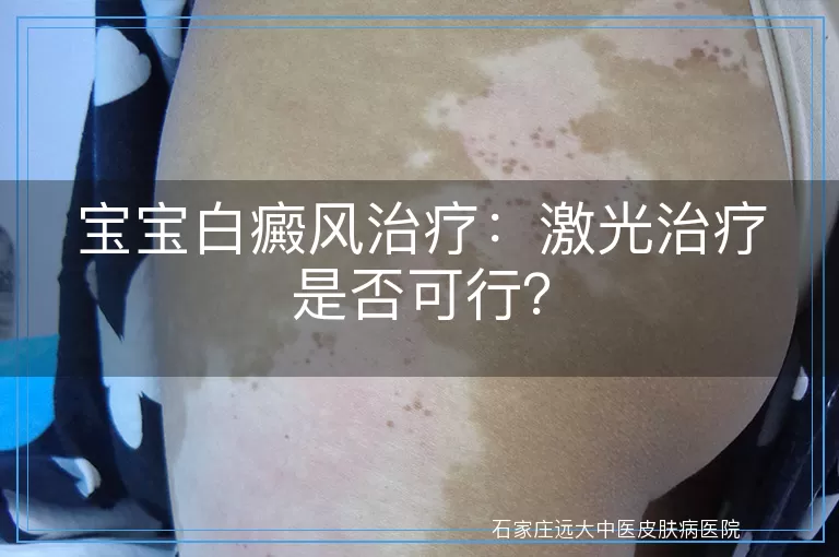 宝宝白癜风治疗：激光治疗是否可行？