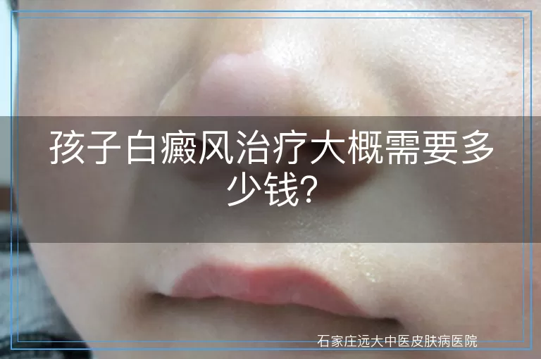 孩子白癜风治疗大概需要多少钱？