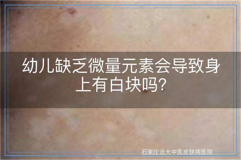 幼儿缺乏微量元素会导致身上有白块吗？