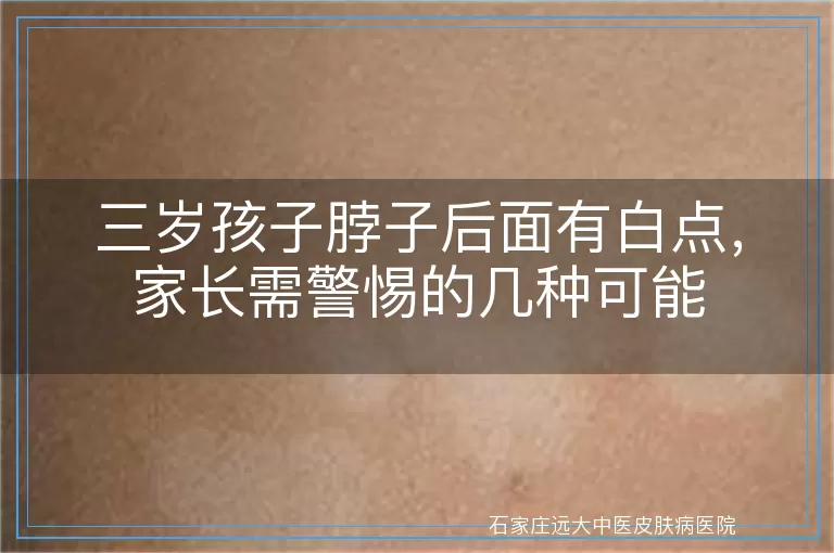 三岁孩子脖子后面有白点，家长需警惕的几种可能