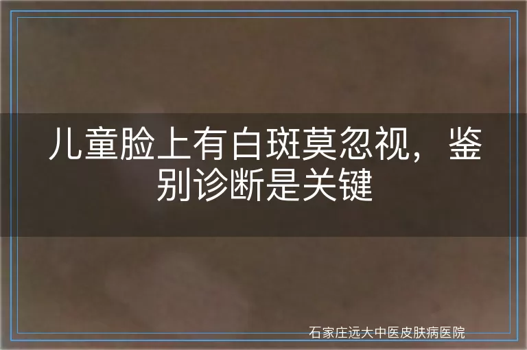 儿童脸上有白斑莫忽视，鉴别诊断是关键