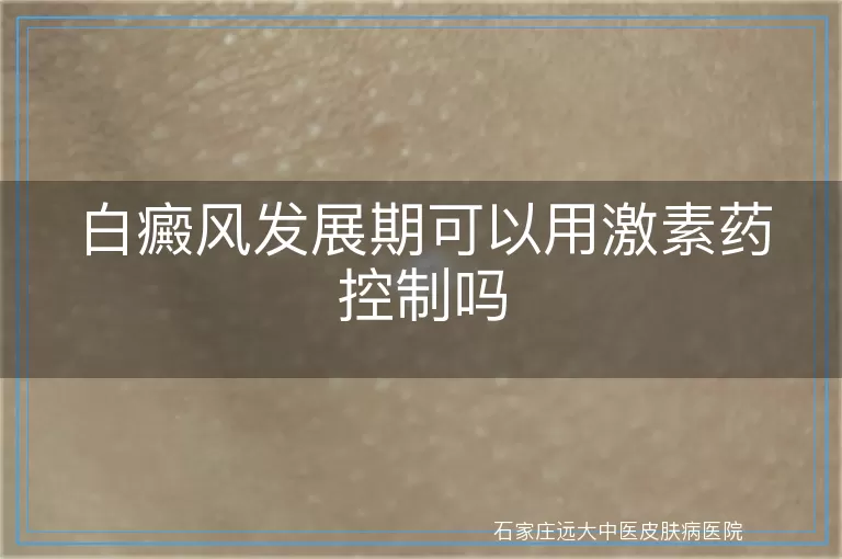 白癜风发展期可以用激素药控制吗