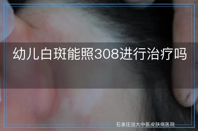 幼儿白斑能照308进行治疗吗