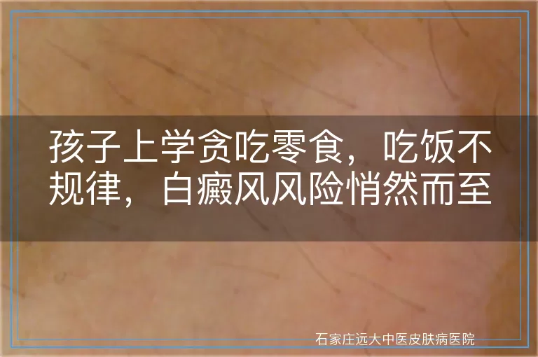 孩子上学贪吃零食，吃饭不规律，白癜风风险悄然而至？
