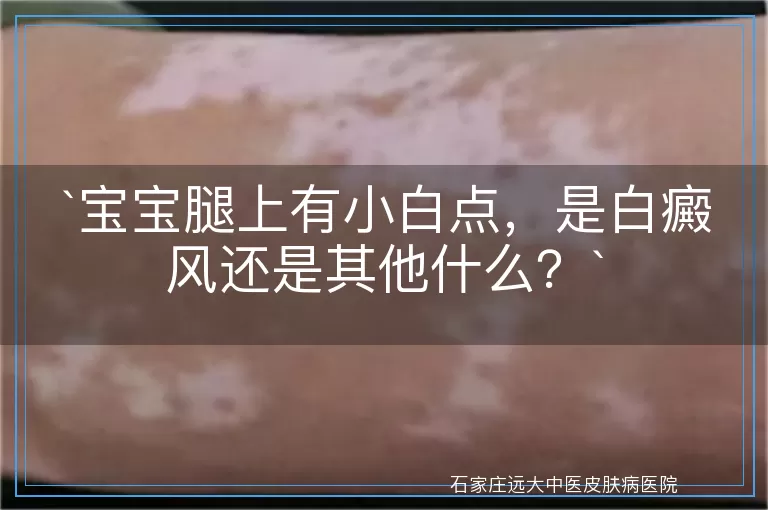宝宝腿上有小白点，是白癜风还是其他什么？
