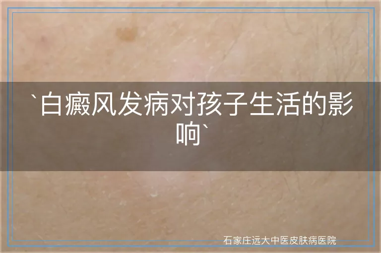 白癜风发病对孩子生活的影响