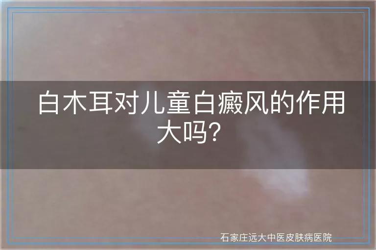 白木耳对儿童白癜风的作用大吗？