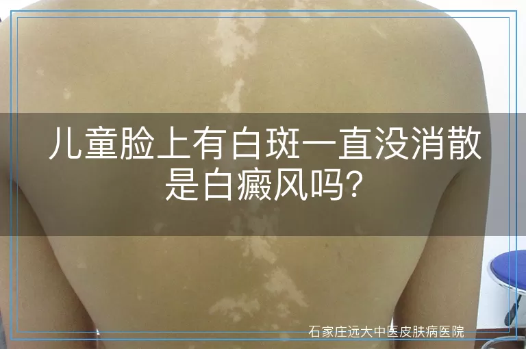 儿童脸上有白斑一直没消散是白癜风吗？