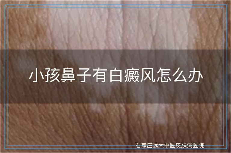 小孩鼻子有白癜风怎么办