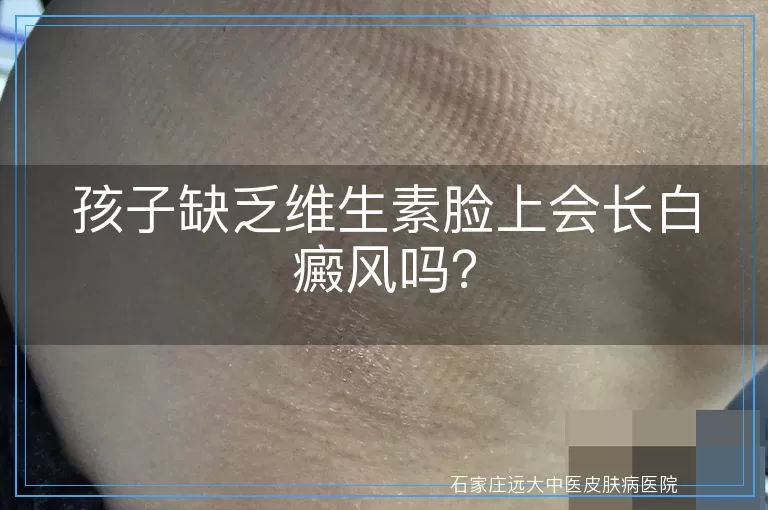 孩子缺乏维生素脸上会长白癜风吗？