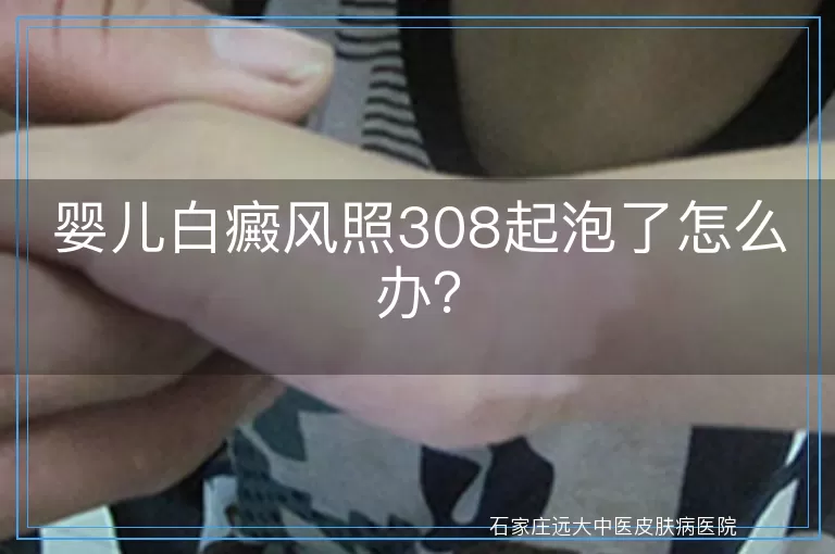 婴儿白癜风照308起泡了怎么办？