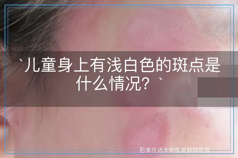 儿童身上有浅白色的斑点是什么情况？
