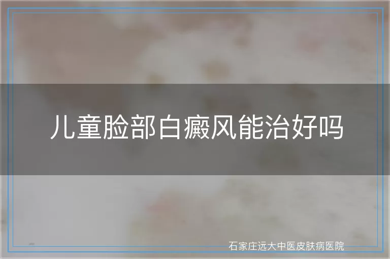 儿童脸部白癜风能治好吗