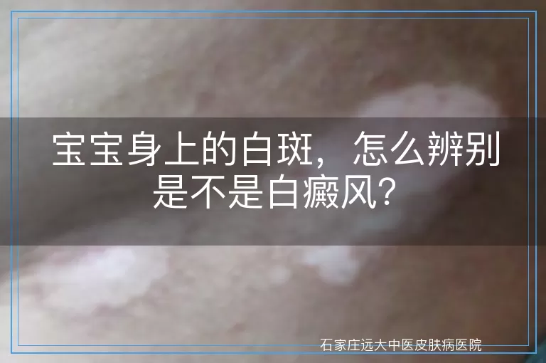 宝宝身上的白斑，怎么辨别是不是白癜风？
