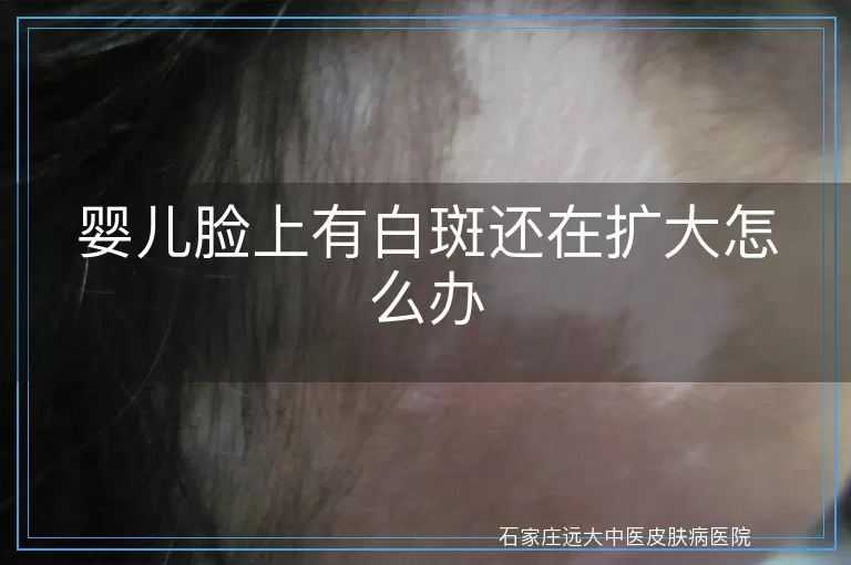 婴儿脸上有白斑还在扩大怎么办