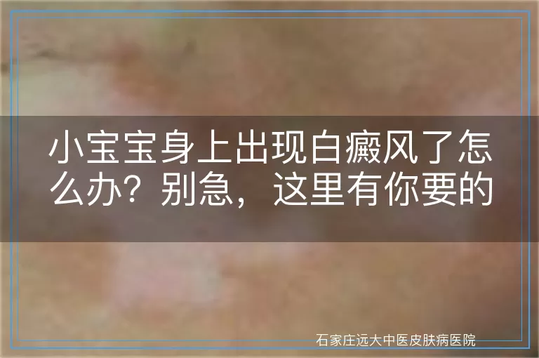 小宝宝身上出现白癜风了怎么办？别急，这里有你要的答案！