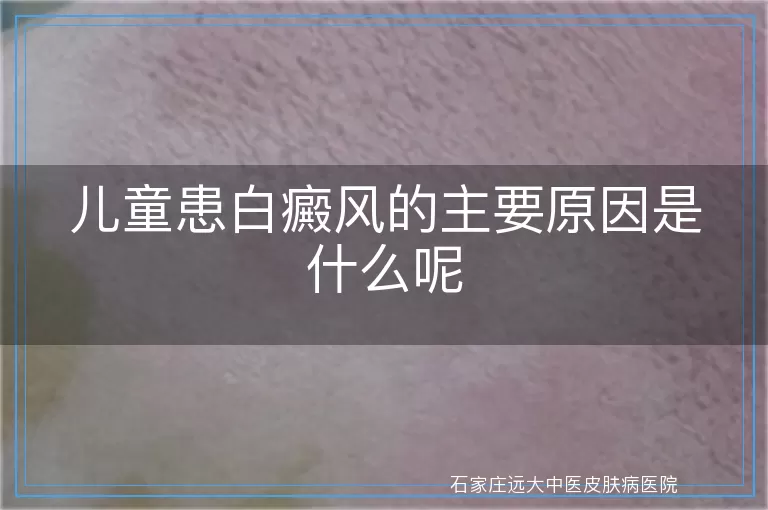 儿童患白癜风的主要原因是什么呢