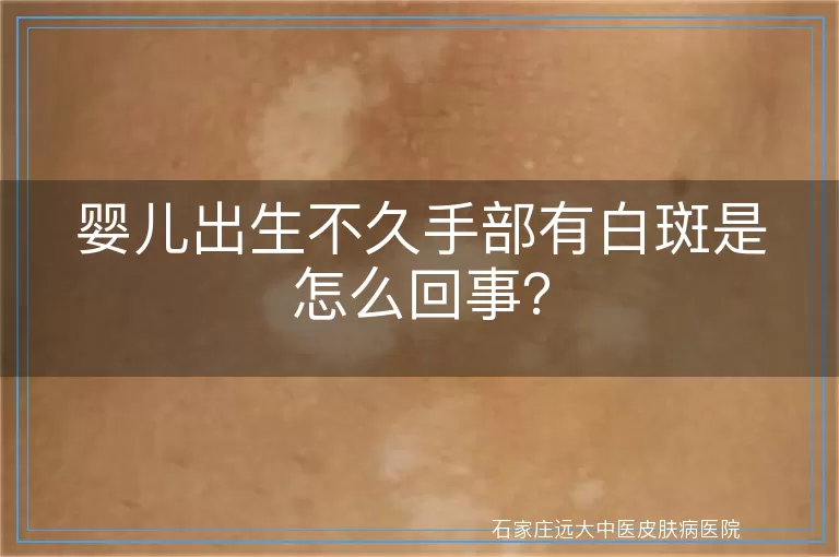 婴儿出生不久手部有白斑是怎么回事？